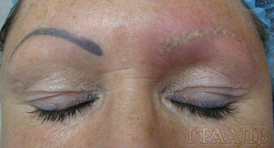 Eliminación de tatuajes de cejas en el salón de belleza El Grial
