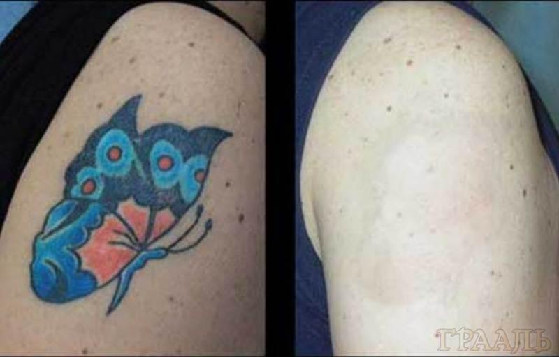 Corrección y eliminación de un tatuaje en el salón de belleza El Grial